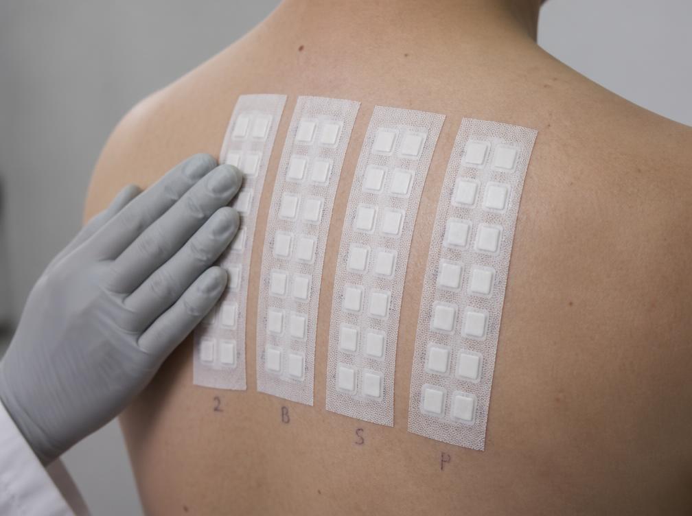 Epikutantestung mit Testpflastern am Rücken