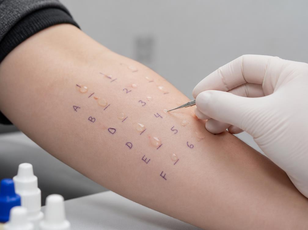 Pricktestung am Unterarm zur Diagnostik von Soforttyp-Allergien